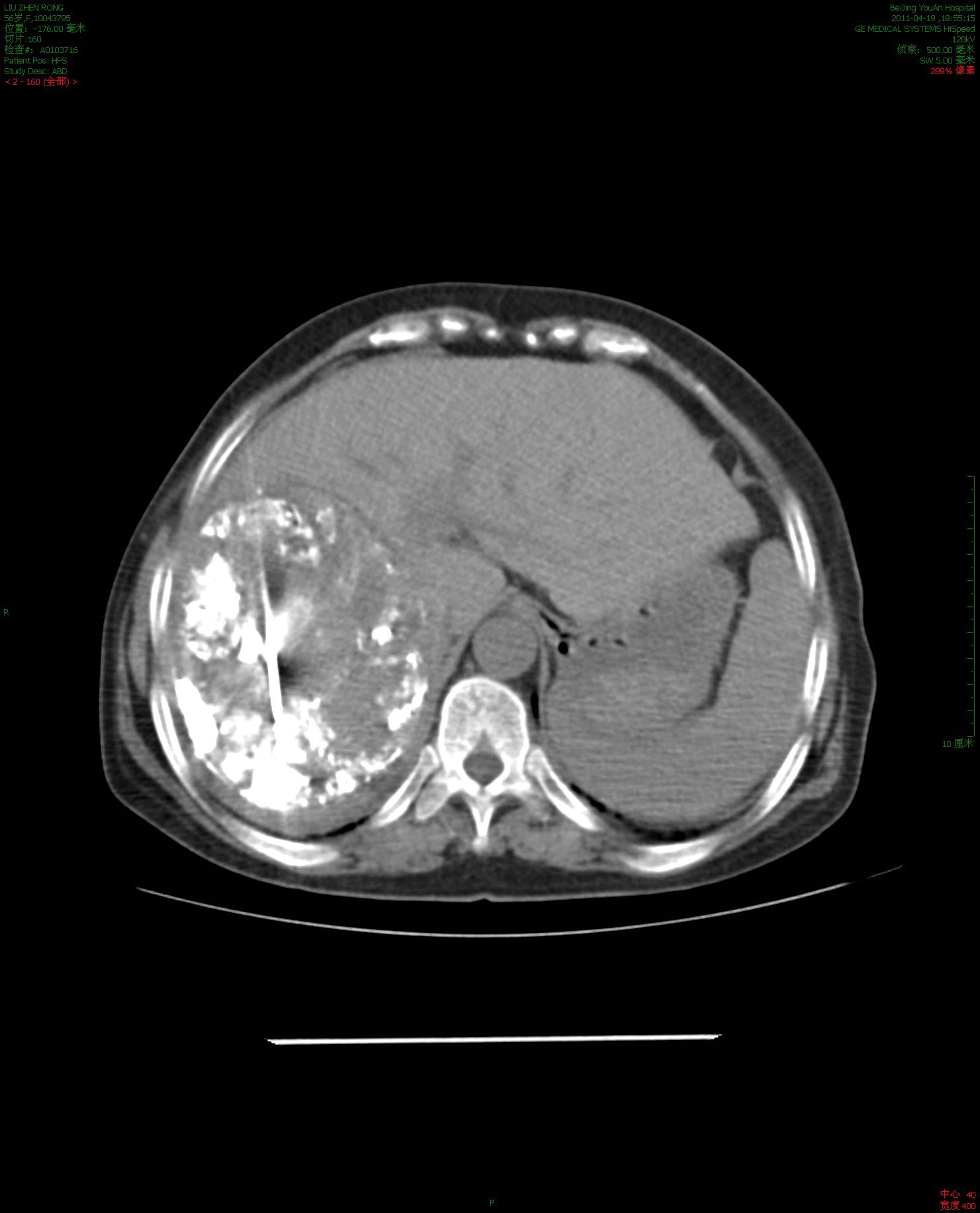 消融肿瘤40%-50%微创治疗前增强ct56岁的肝癌晚期患者,女性