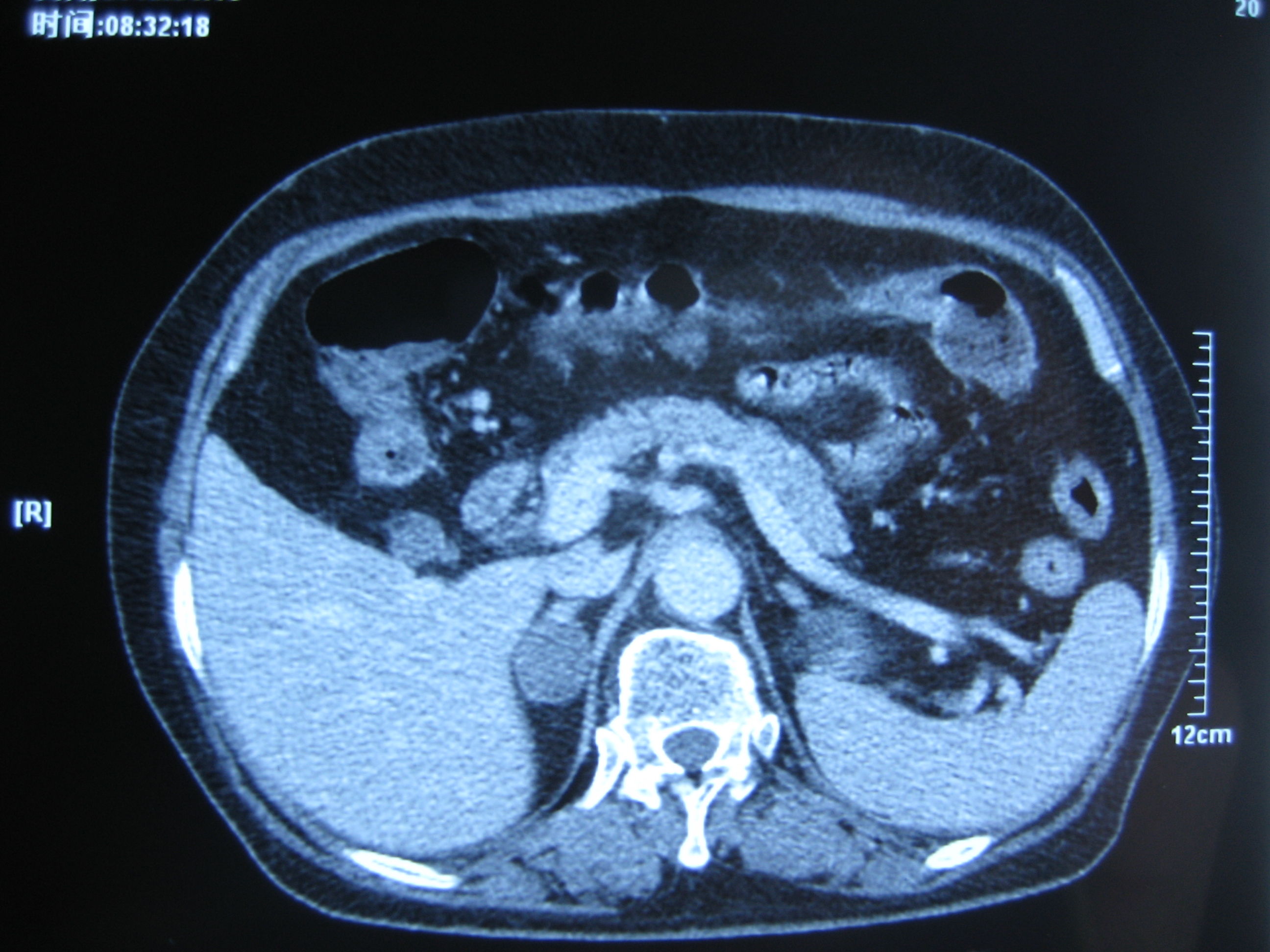 典型病例之六:右肾上腺腺瘤腹腔镜切除 - 好大夫在线