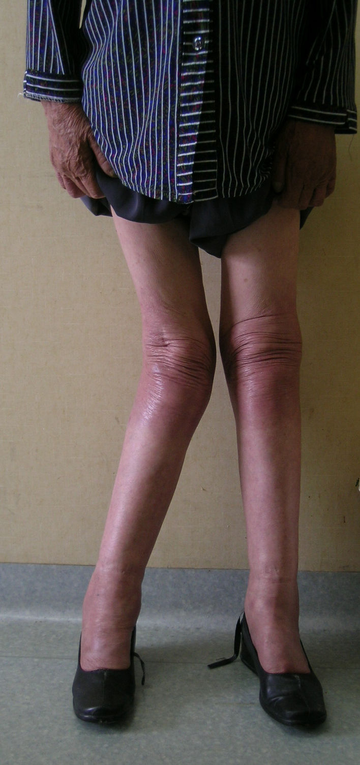 高难度手术之六:严重膝关节反屈畸形 - 好大夫在线