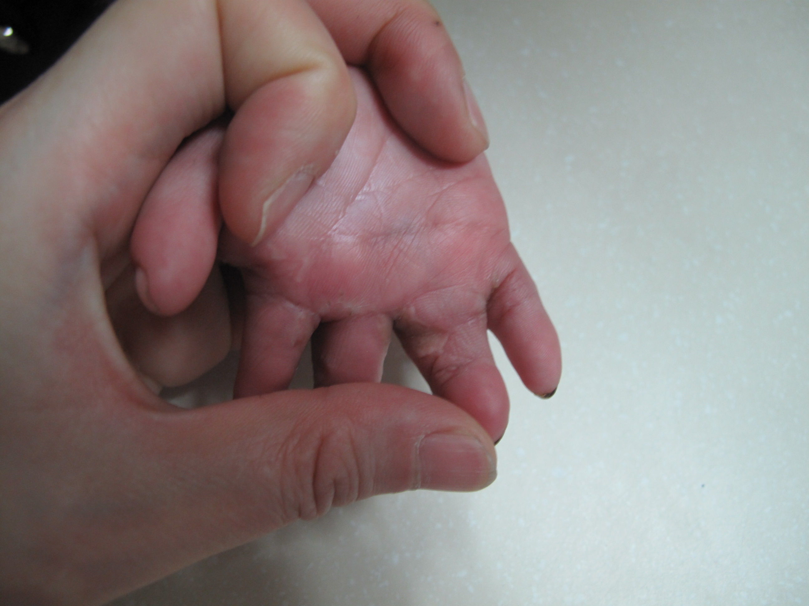 短指并指(波兰综合症):一次手术全部分离多个手指的并连_先天性并指