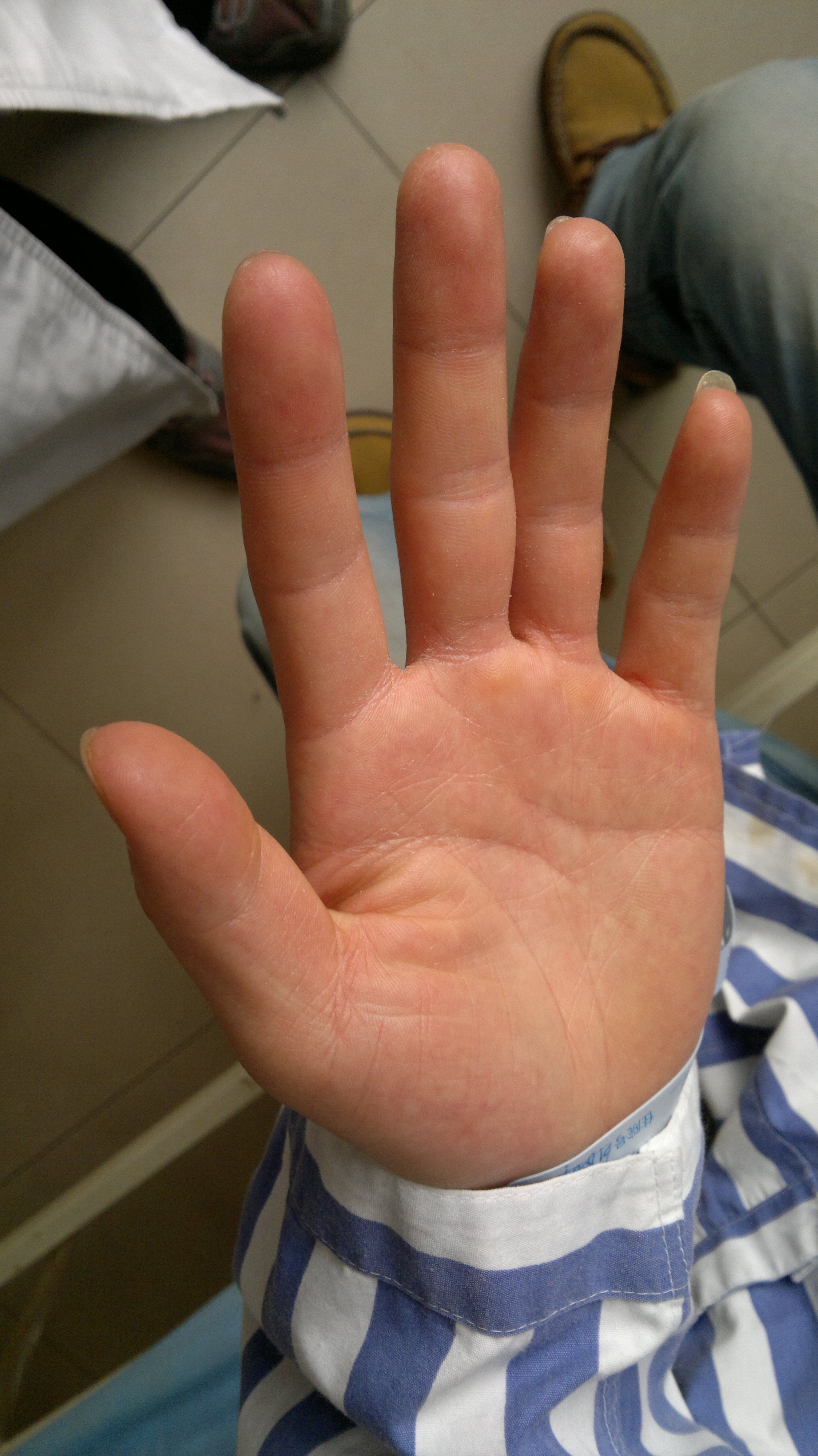 手汗症患者术后不同表现:一手部皲裂;一手较为正常!