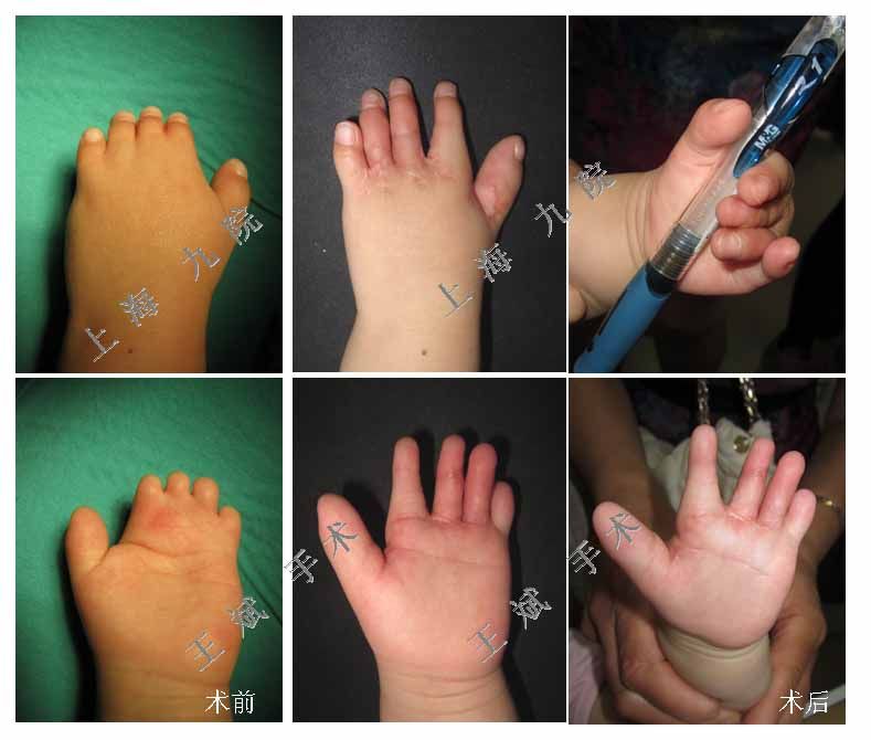 短指畸形的治疗 - 好大夫在线