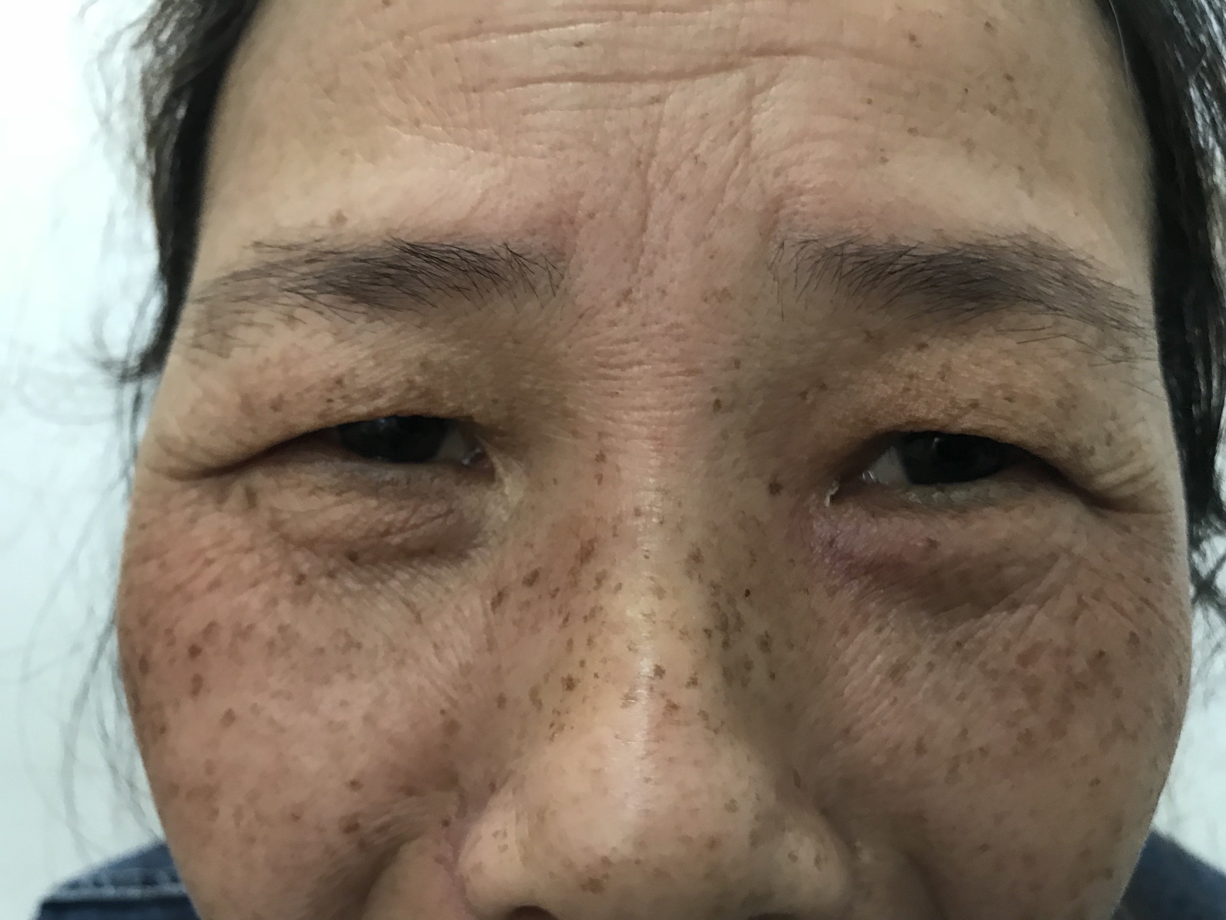 见过这么严重的急性泪囊炎吗