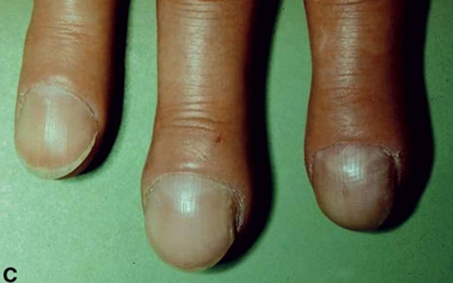 甲亢的特殊症状_甲亢_症状_症状表现 - 好大夫在线