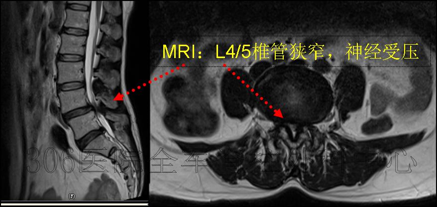 腰椎滑脫典型病例1