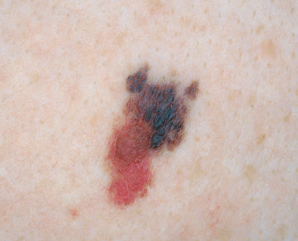 歪草变大花,这就是对一颗痣的颜值考验,您记住了么?让我们实战一下.