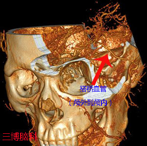 顳淺動脈-大腦中動脈搭橋治療煙霧病