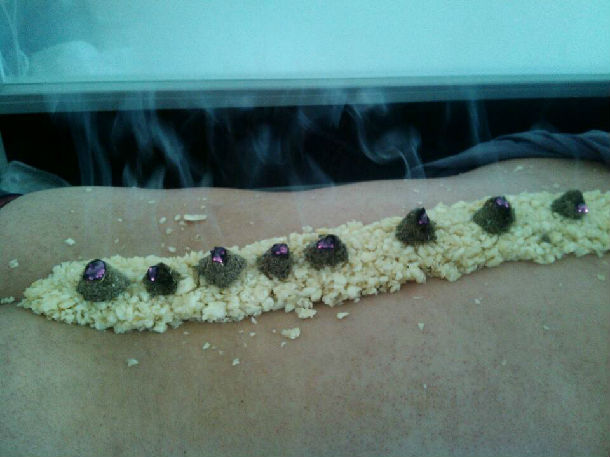 隔大蒜灸(长蛇灸)治疗强直性脊柱炎一例 - 好大夫在线