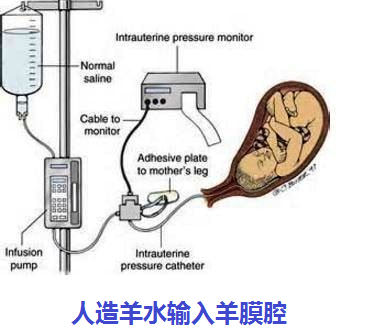 孕周破水 宫颈机能不全还是子宫肌瘤原因 流产 流产病因