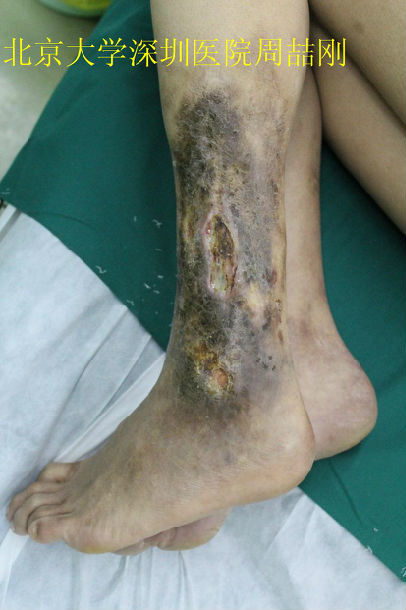 慢性骨髓炎的显微外科治疗 - 好大夫在线