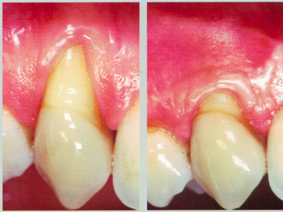 什麼樣的牙齦退縮能夠通過手術治療恢復正常