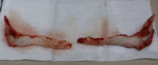 下颌角肥大的不同的截骨手术方式