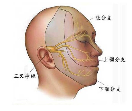 三叉神经痛具体都是哪些部位痛? 