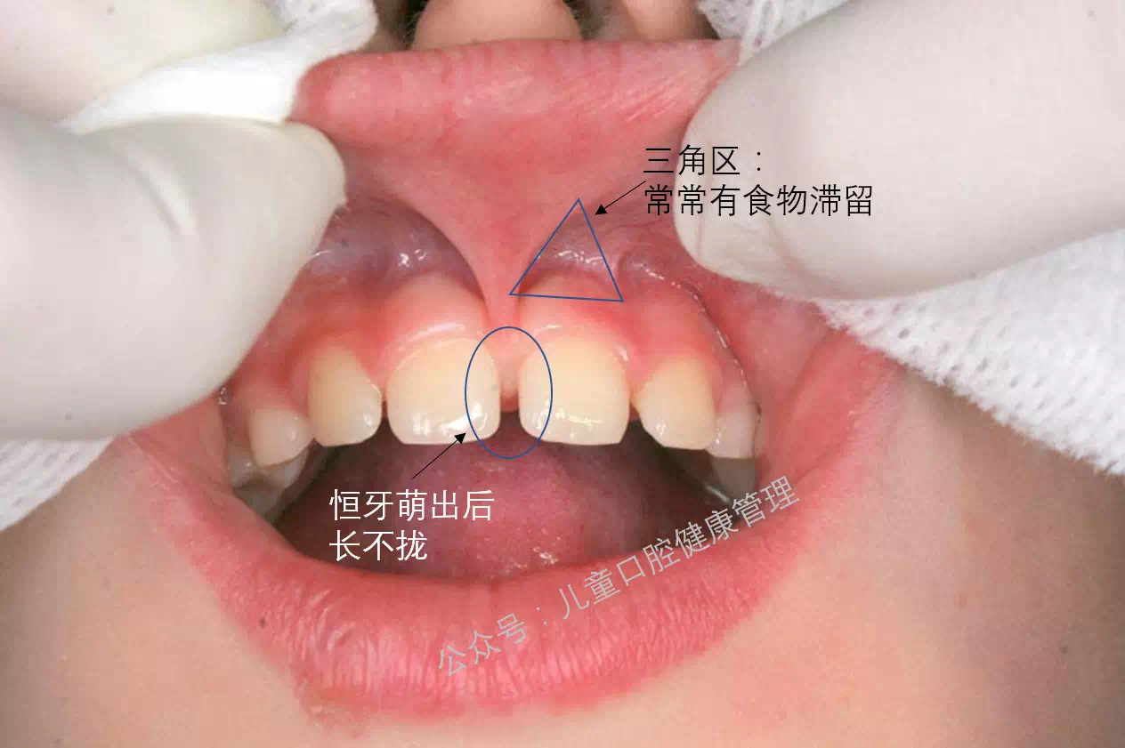 成年患者牙齿矫正伴有舌系带过短的医学科普—程德盛牙齿整形博客