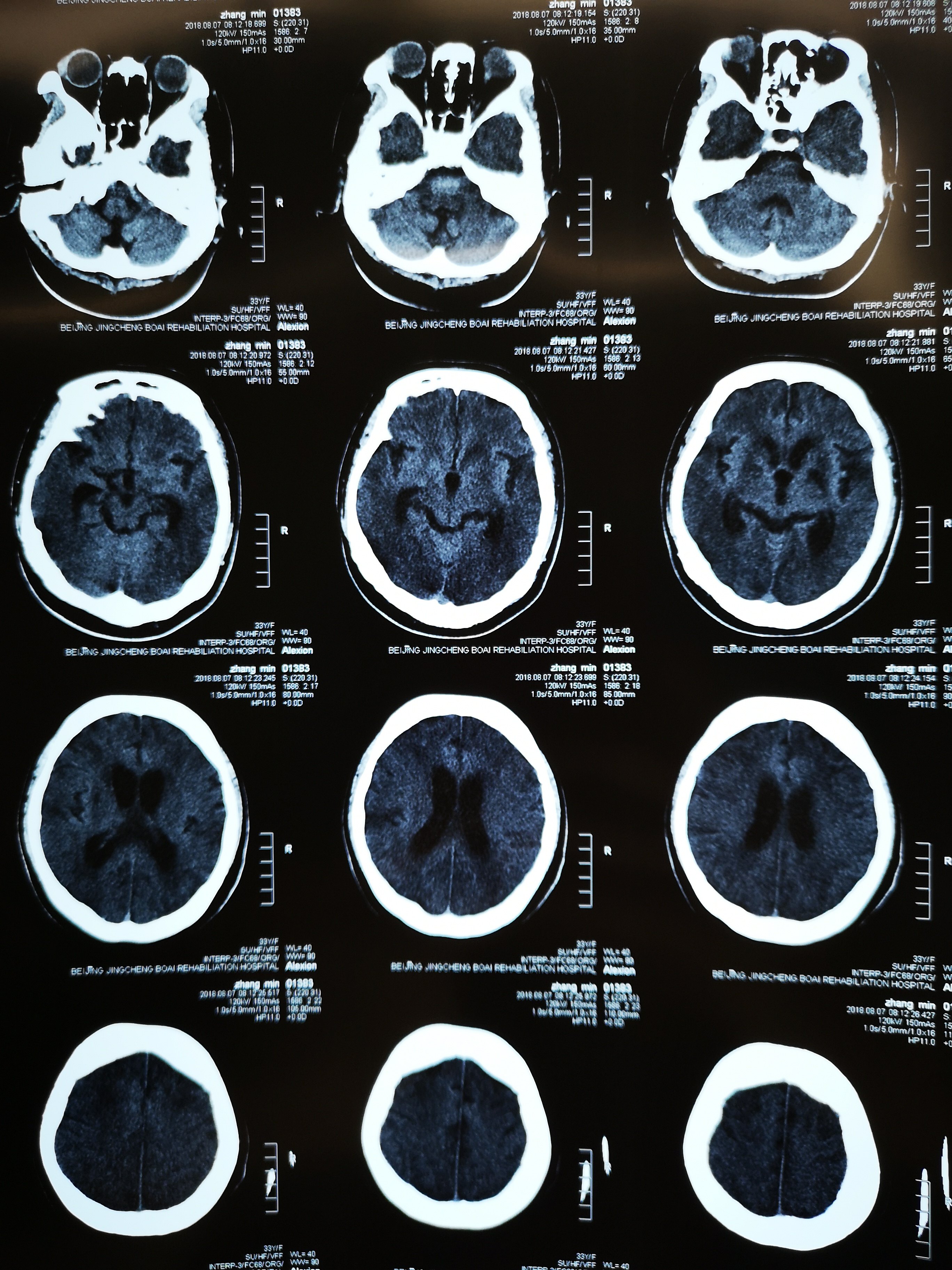 产前肺部感染窒息缺血缺氧性脑病微创手术后好转