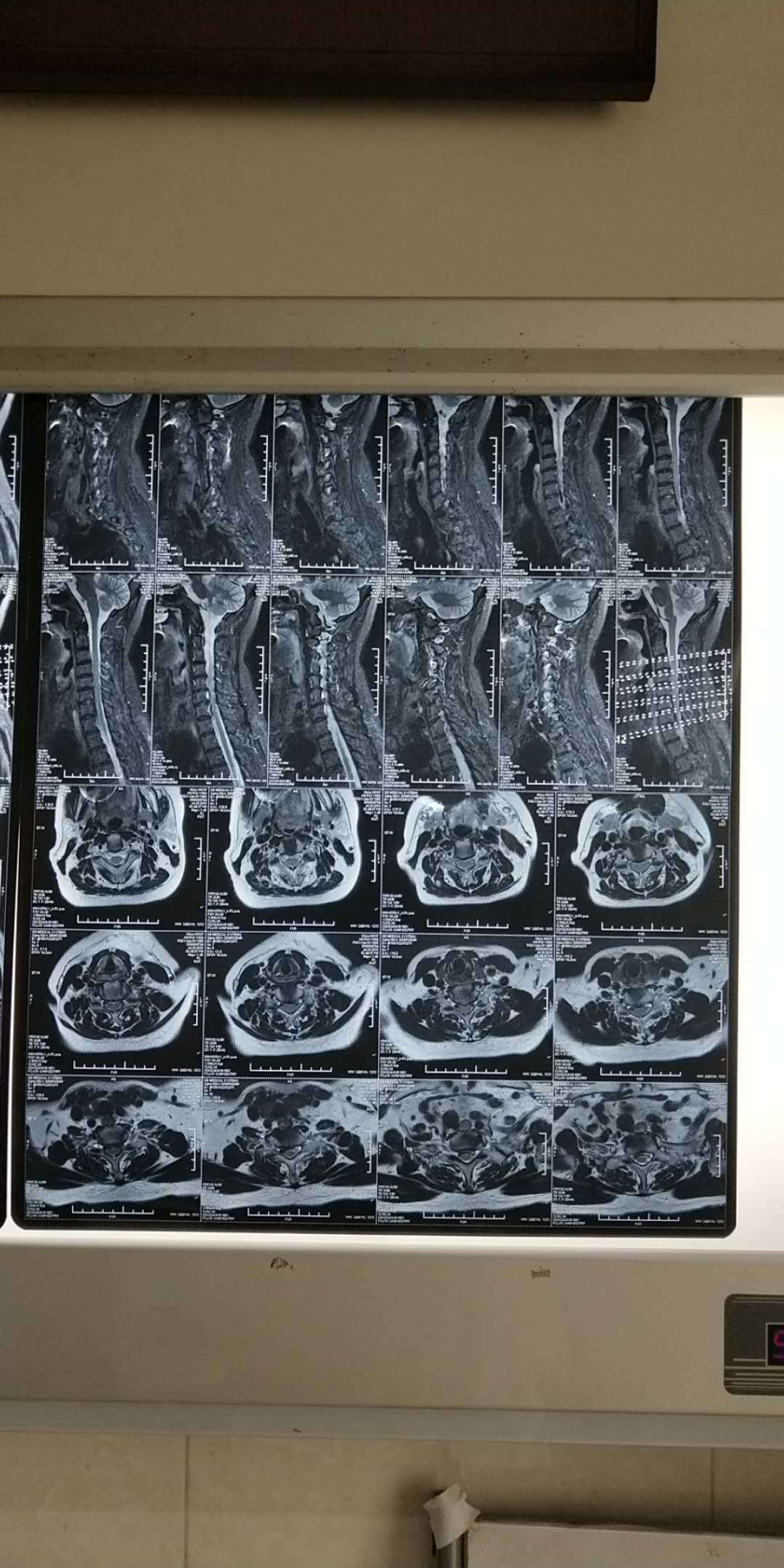 神经根型颈椎病ct图片图片