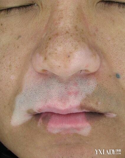 唇发白,警惕白癜风!