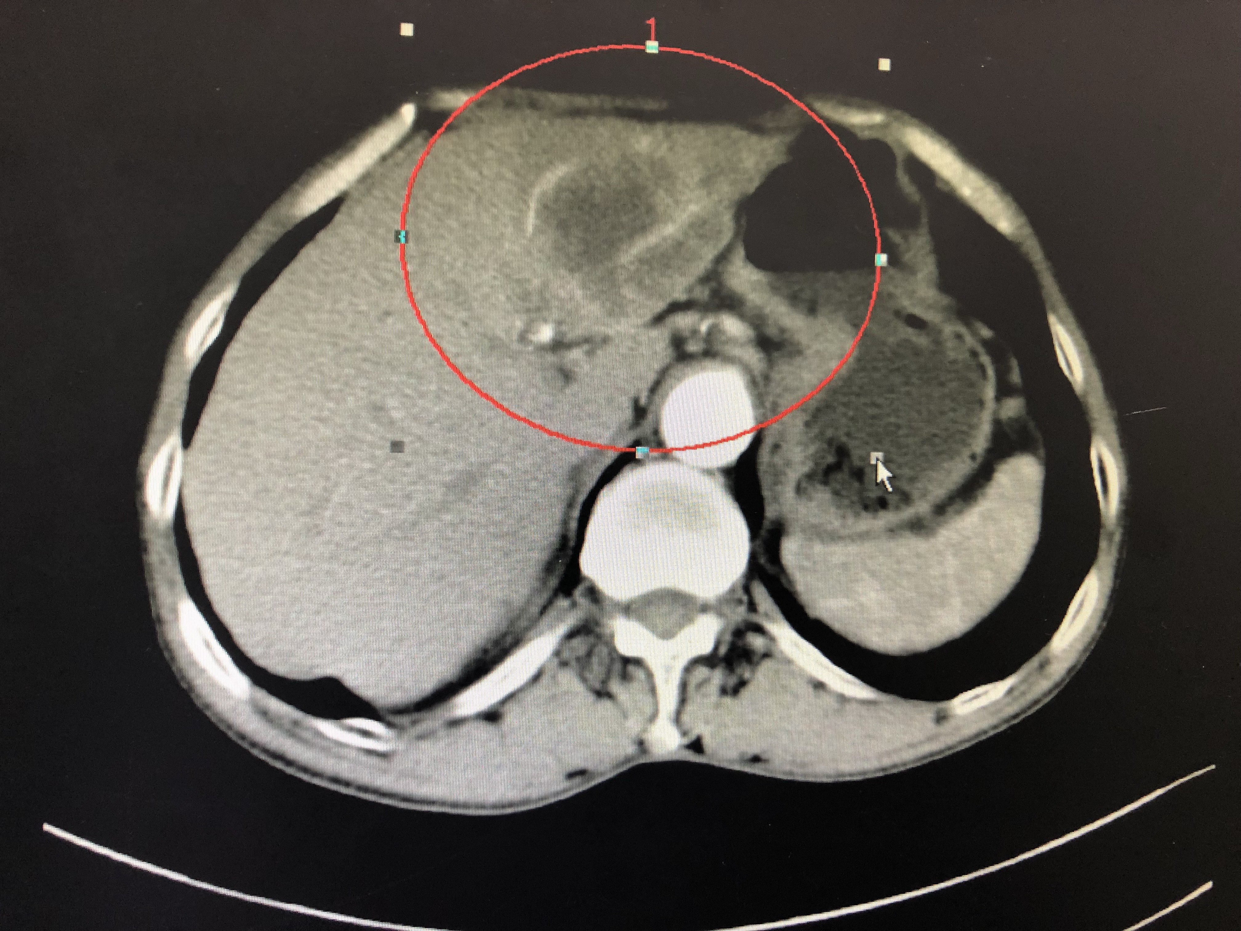 腹腔镜左肝外叶切除术治疗肝胆管细胞癌一例 - 好大夫在线