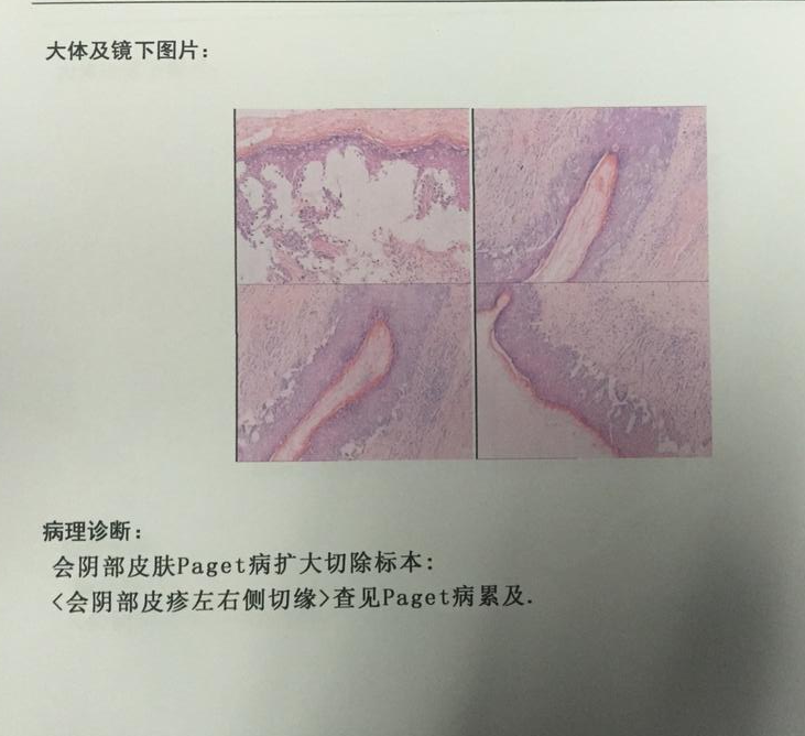 真的是湿疹吗警惕pagets病
