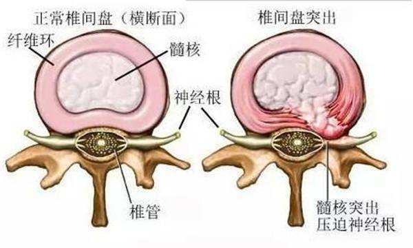 神经根型颈椎病 最常见 手术效果最好的颈椎病 神经根型颈椎病 疾病介绍 病因 症状 检查 日常护理
