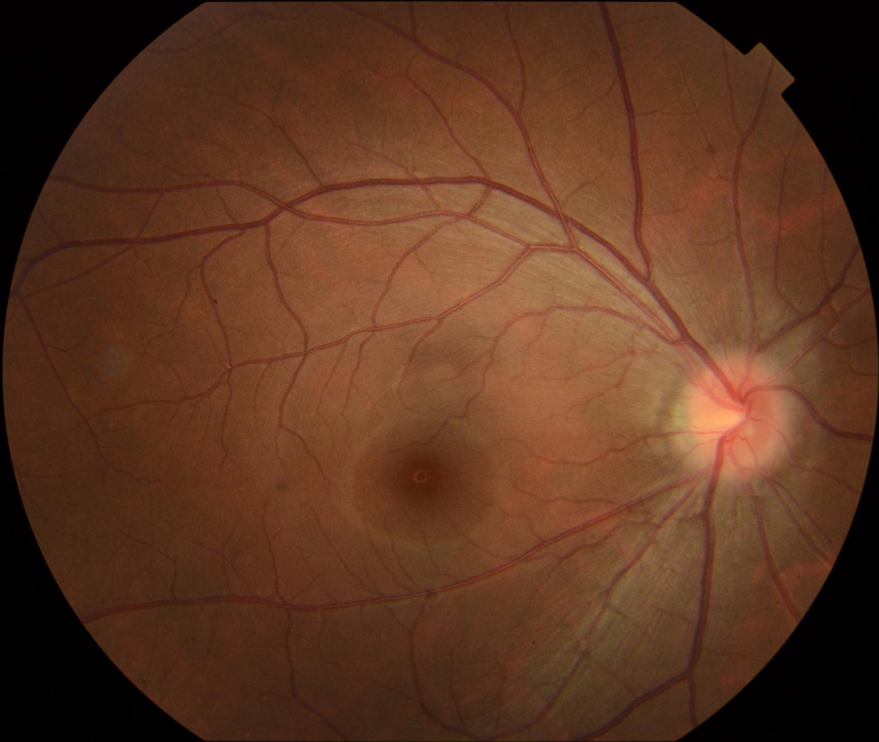 药物中毒性视神经病变 - 好大夫在线