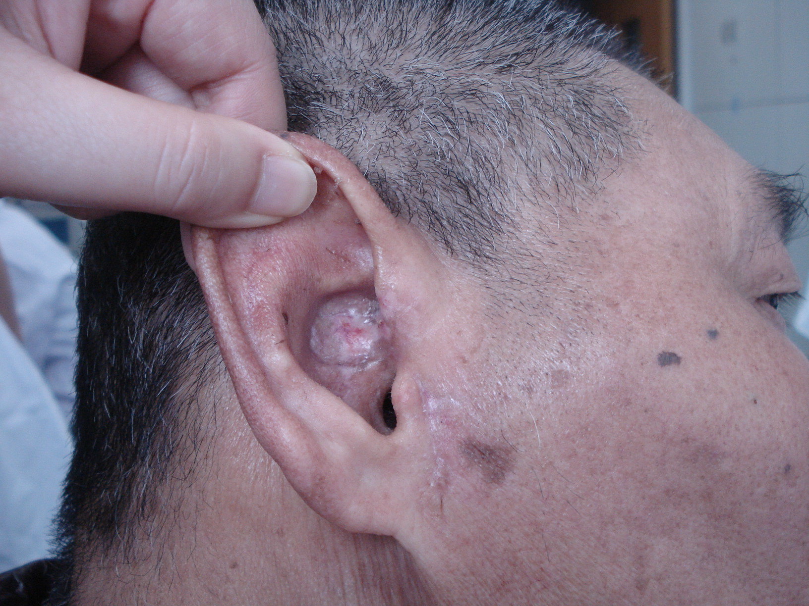 腮腺淋巴瘤图片耳朵图片