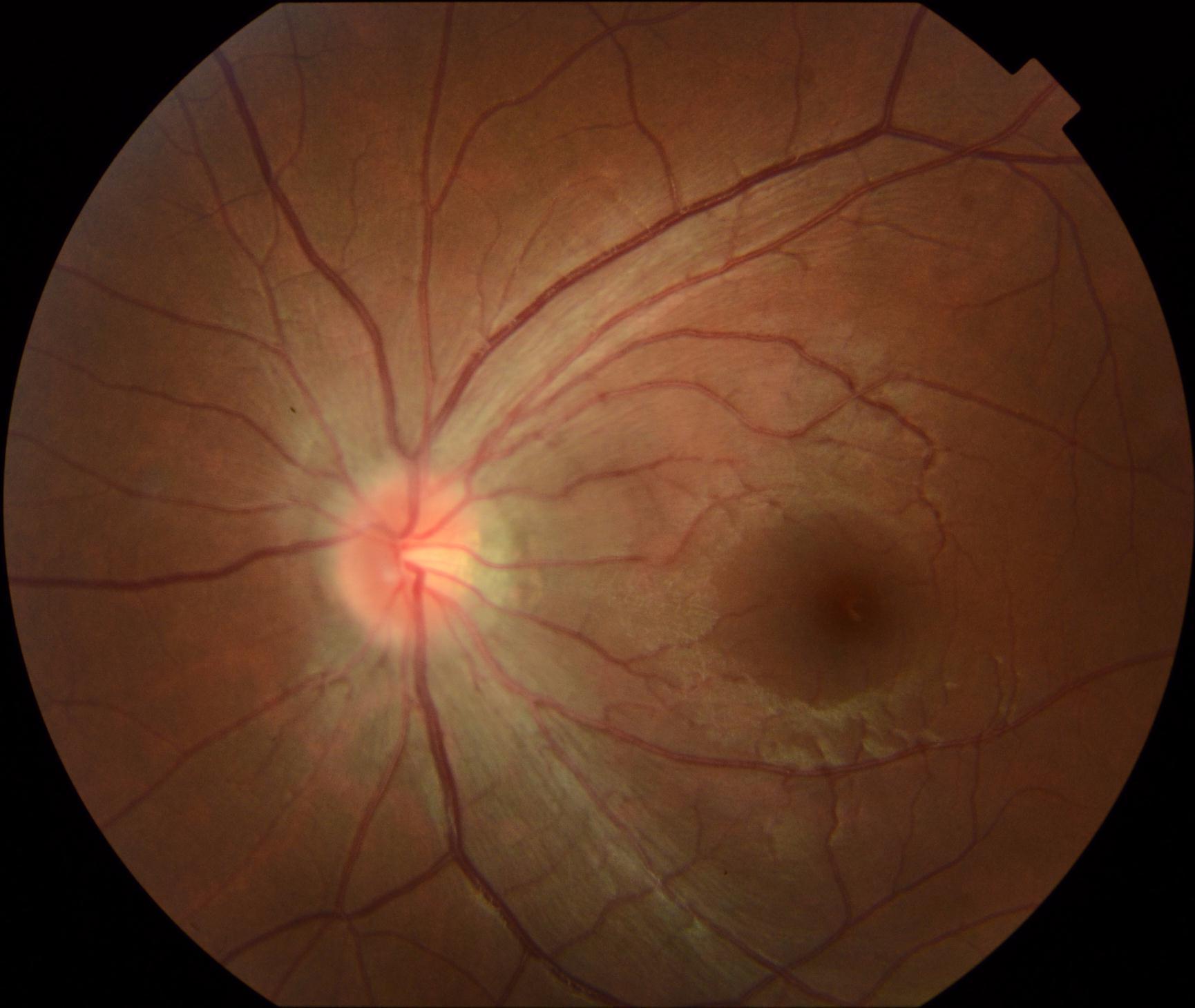 药物中毒性视神经病变 - 好大夫在线