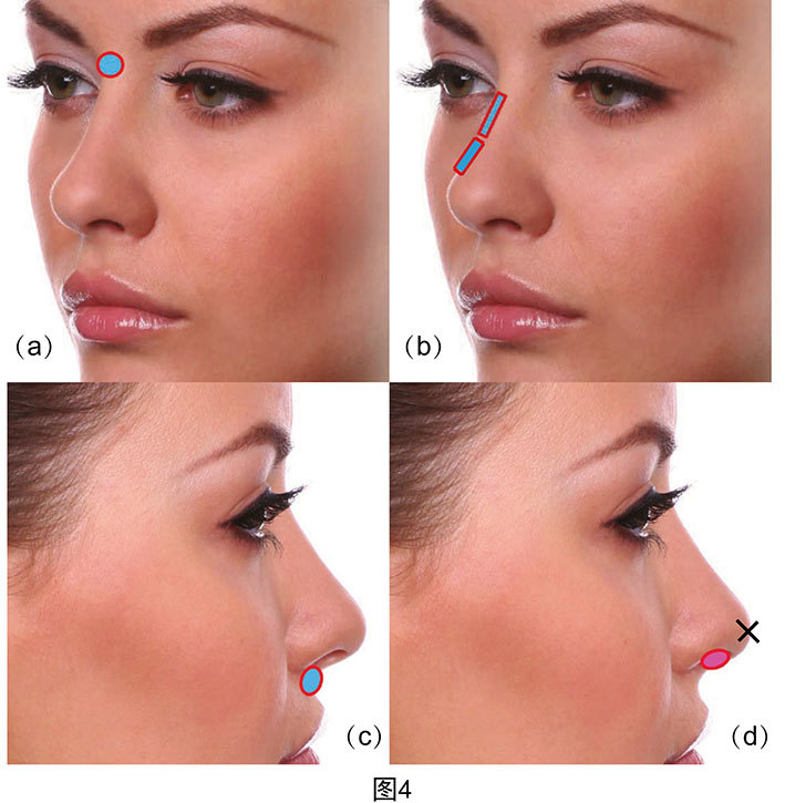 (三)增加鼻尖凸起度:保持在中线,贴近前鼻棘骨膜注射,同时要避免注射