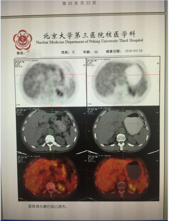 肺癌射波刀放射治疗联合靶向治疗疗效好