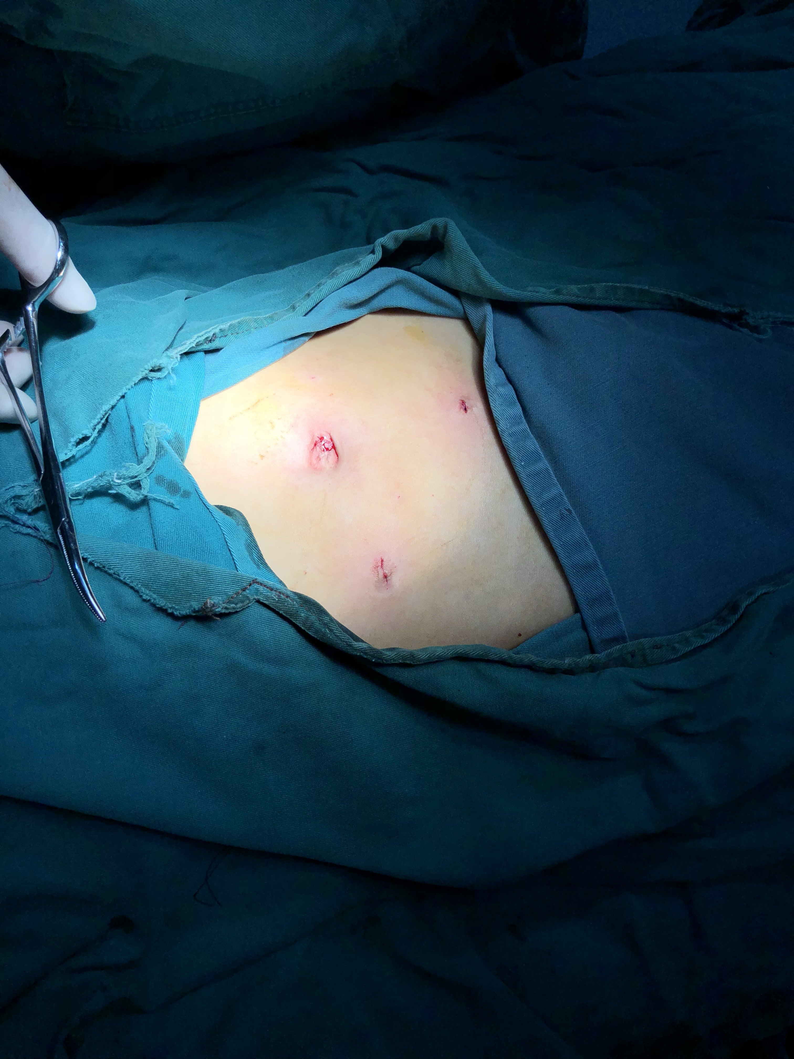 女人阑尾炎手术图片图片