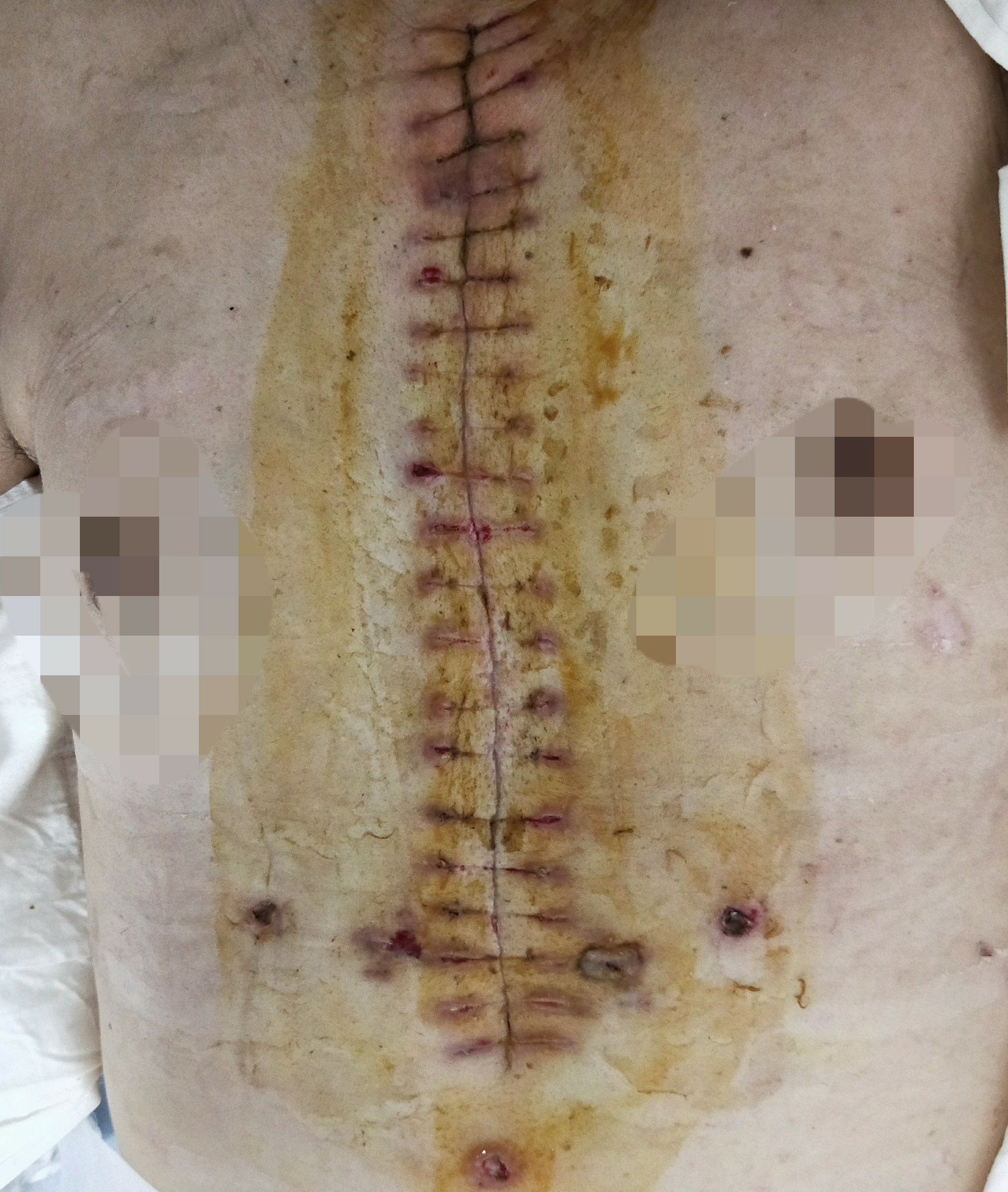 心脏介入手术后伤口图图片