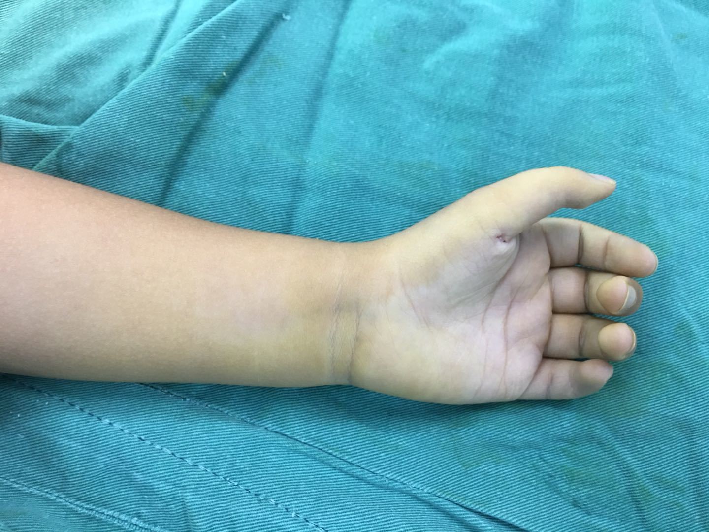 牵拉肌腱远端被动同主动病例2xxx 女 4岁 双拇先天扳机指治疗时间延误