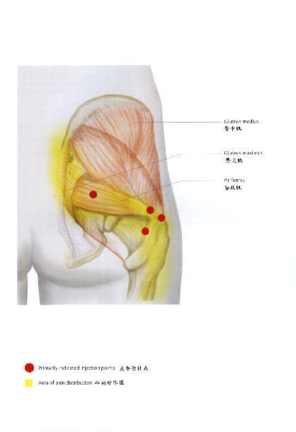 梨状肌体表定位图片