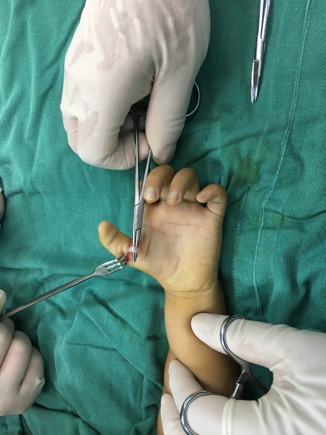 女 4岁 双拇先天扳机指治疗时间延误!