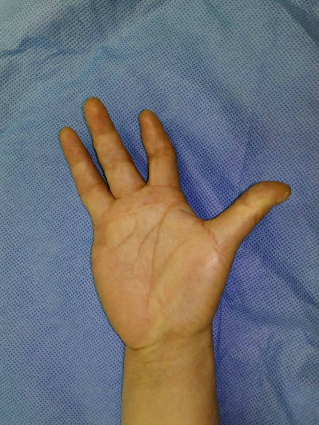 我院开展鲁西南首例断指再植后掌指关节置换手术