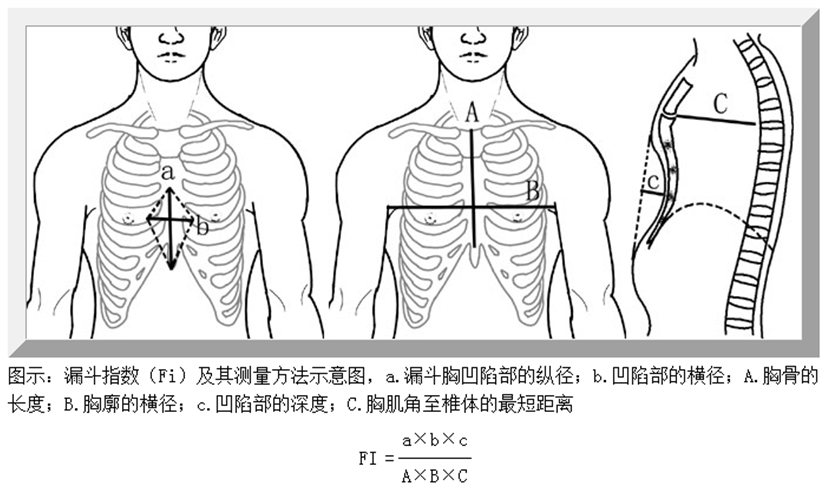 漏斗胸的诊断包括4个方面的内容,即确诊,明确程度和判断有无胸腔脏器