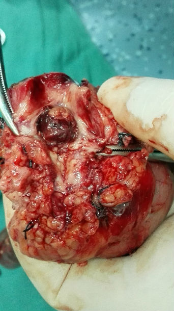 胰十二指肠切除术治疗胰十二指肠动脉瘤大出血1例 - 好大夫在线