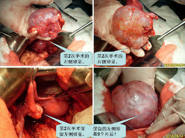腹膜假黏液瘤病例(9)--生育期卵巢留还是不留? - 好大夫在线