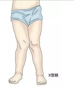 中老年人膝盖疼痛:您有可能得了膝关节骨性关节炎(一)! (转载)