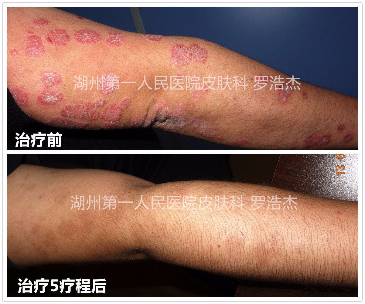 中医中药治疗在银屑病(牛皮癣)治疗上的临床案例_银屑病_中医疗法