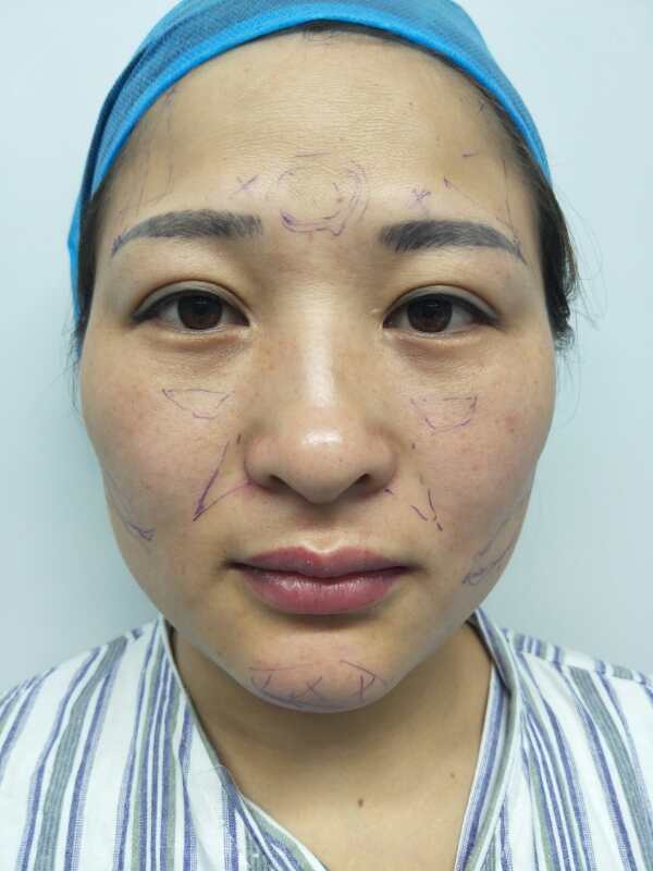 全面部脂肪填充 - 好大夫在线