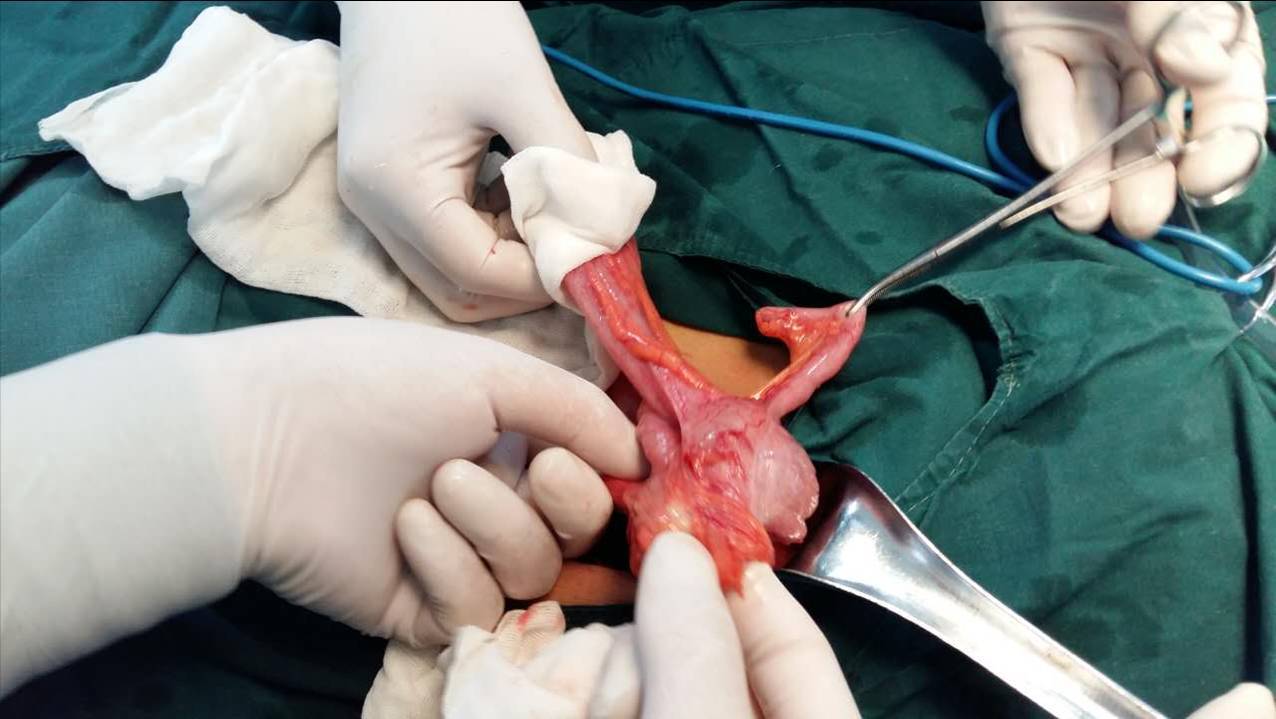 回盲套伴急性肠梗阻一例