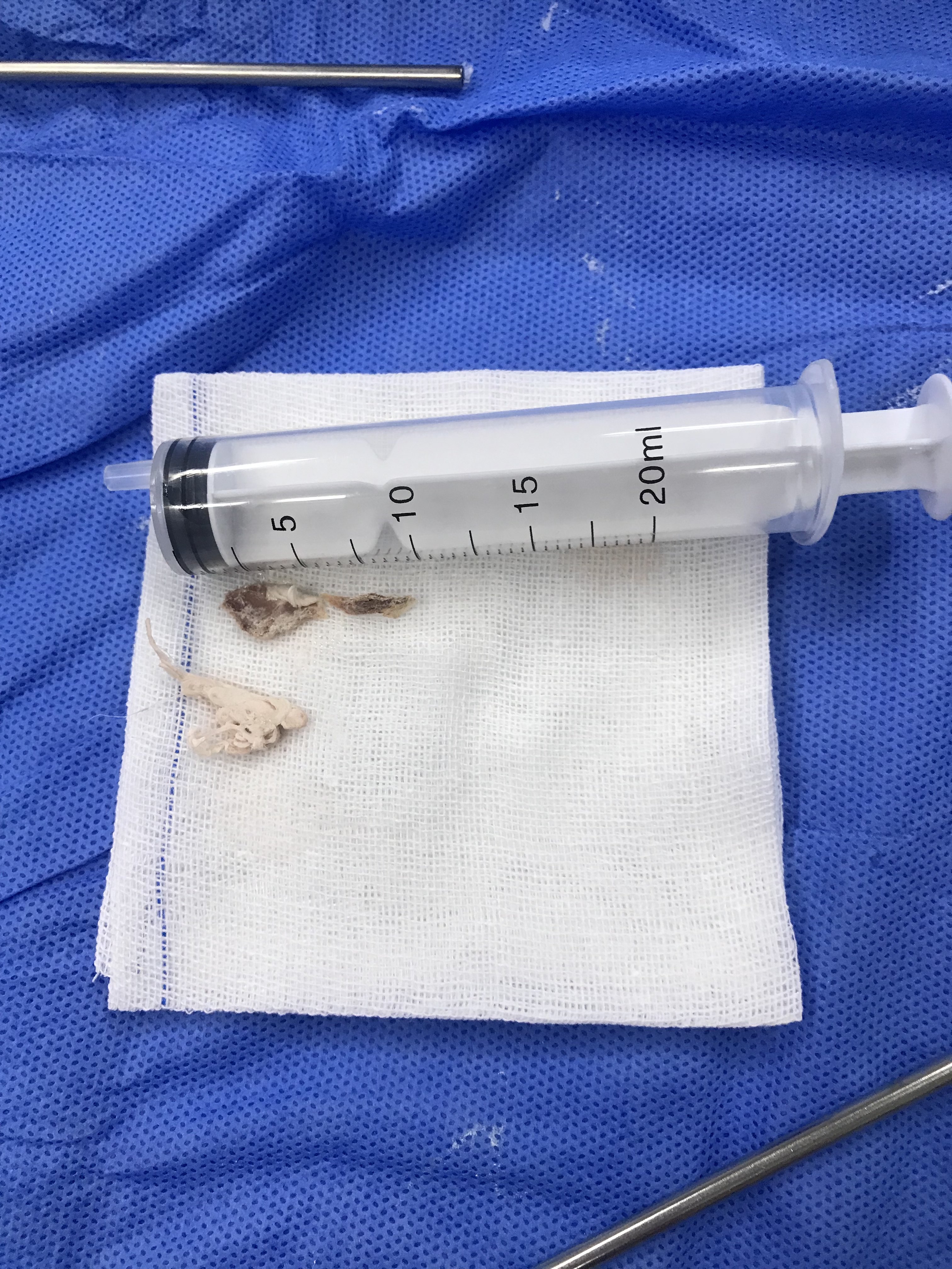 儿童食道异物一例 - 好大夫在线