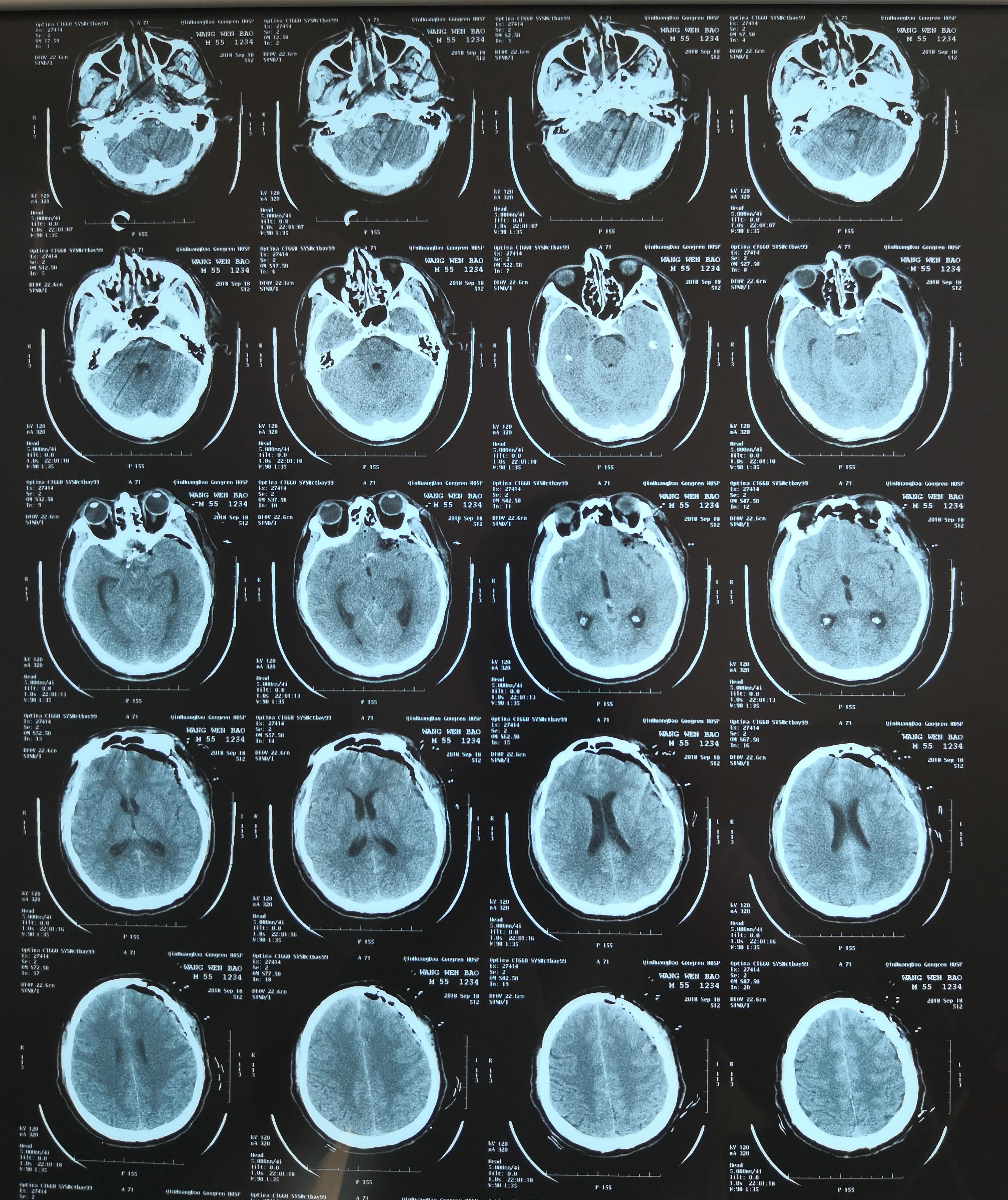 cta检查:前交通动脉瘤术前ct片显示颅内蛛网膜下出血因为动脉瘤的管壁