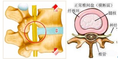 <!--HAODF:8:yaozhuijianpantuchu-->腰椎间盘突出<!--HAODF:/8:yaozhuijianpantuchu-->1.jpg