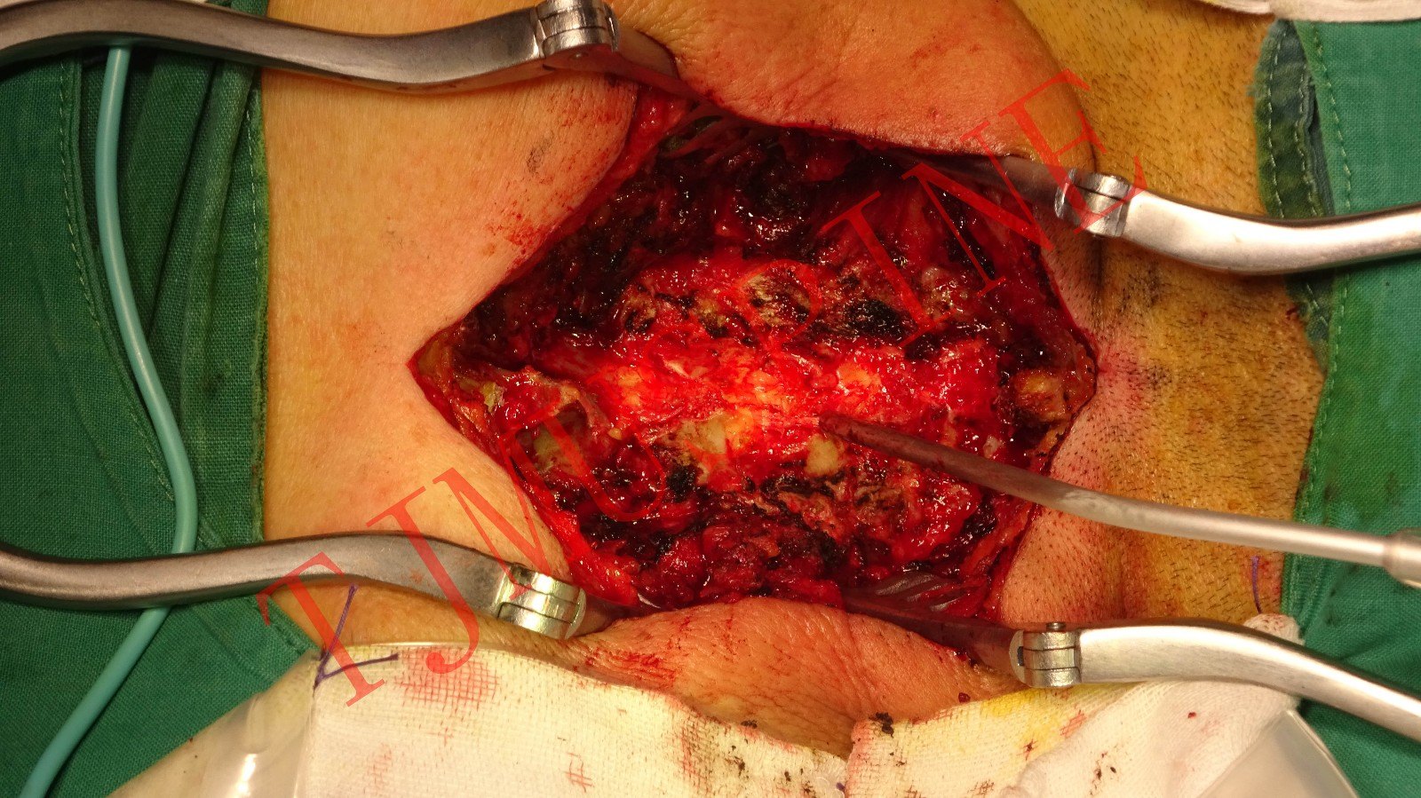 颈后路椎板切除椎管减压术 - 好大夫在线