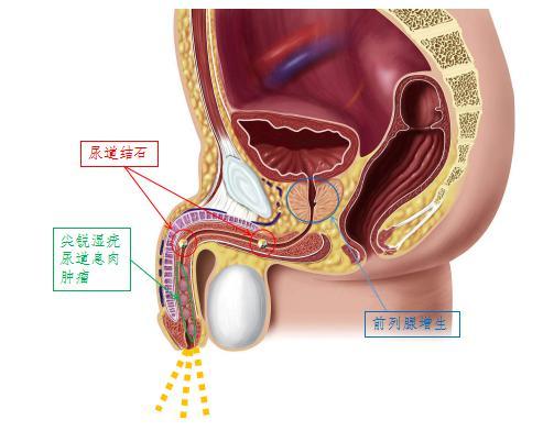 尿分叉疾病1.jpg