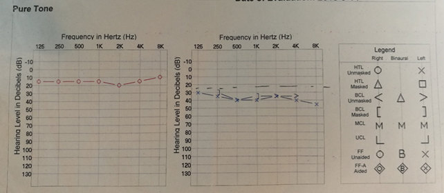 右侧基本正常,听阈平均在15db,好于中国25 db的标准;左侧感音神经性聋