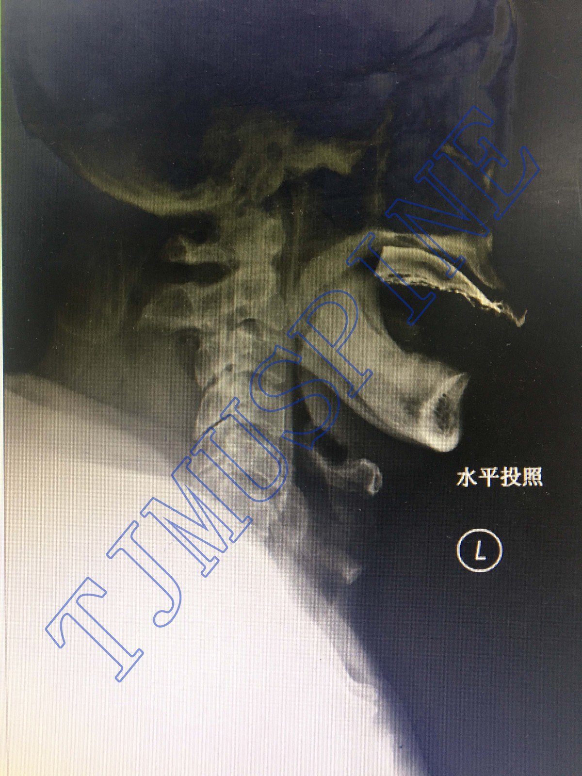 脊髓损伤磁共振图片