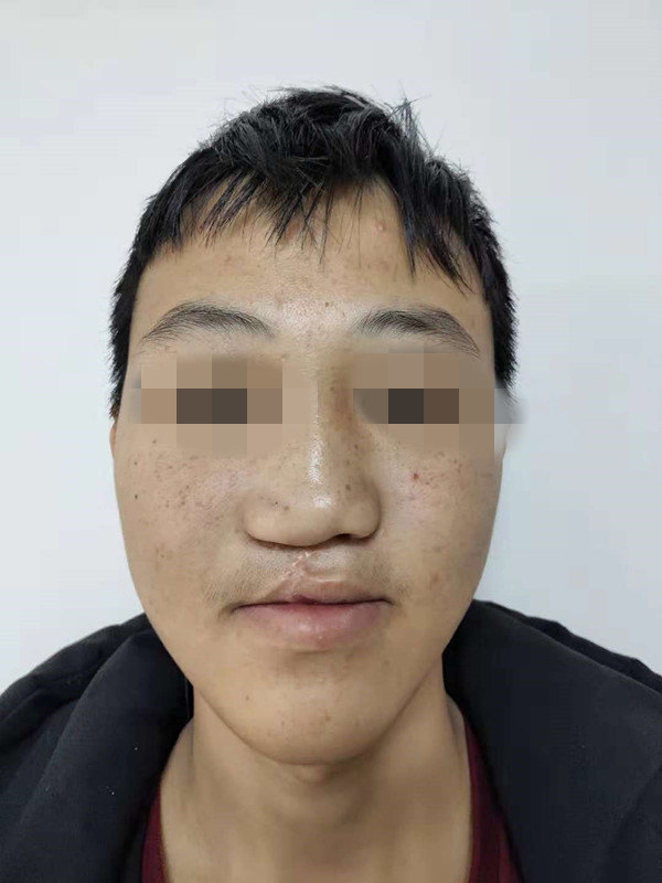 唇裂术后鼻唇畸形(鼻中隔发育不良)整复 肋软骨移植 - 好大夫在线